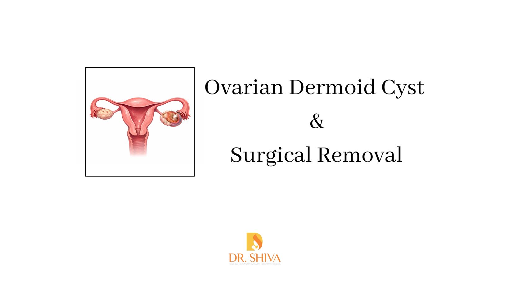 Ovarian Dermoid Cyst and Surgical Treatment
